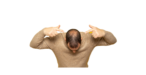 tratament cu laser pentru alopecie androgenică(